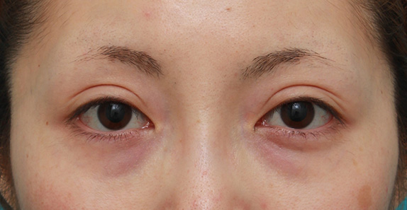 目の下のクマ治療,目の下の脂肪の膨らみを取らず、ヒアルロン酸注射でクマを改善させた症例写真,Before,ba_kuma016_b01.jpg