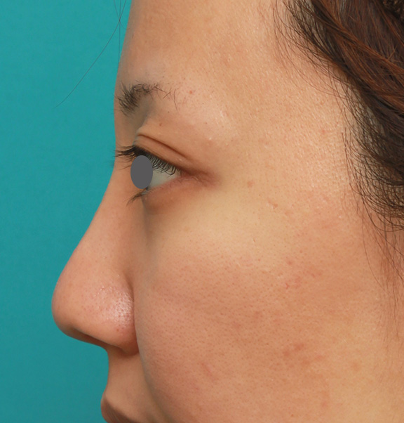 隆鼻注射（ヒアルロン酸注射）,凹凸のない平らな顔に長期持続型ヒアルロン酸を注射し、鼻筋を通した症例　術前術後画像,After（1ヶ月後）,ba_ryubi2027_b03.jpg