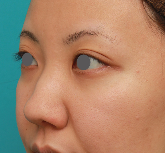 隆鼻注射（ヒアルロン酸注射）,凹凸のない平らな顔に長期持続型ヒアルロン酸を注射し、鼻筋を通した症例　術前術後画像,Before,ba_ryubi2027_b02.jpg