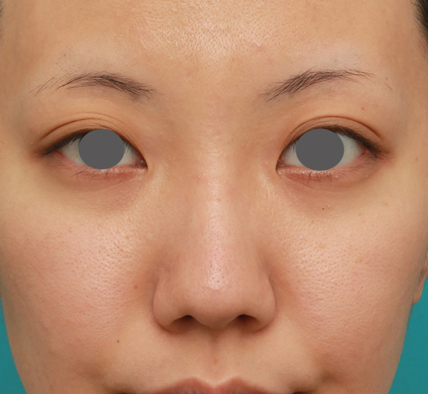 隆鼻注射（ヒアルロン酸注射）,凹凸のない平らな顔に長期持続型ヒアルロン酸を注射し、鼻筋を通した症例　術前術後画像,1週間後,mainpic_ryubi2027c.jpg