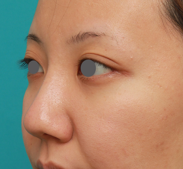 隆鼻注射（ヒアルロン酸注射）,凹凸のない平らな顔に長期持続型ヒアルロン酸を注射し、鼻筋を通した症例　術前術後画像,1週間後,mainpic_ryubi2027g.jpg