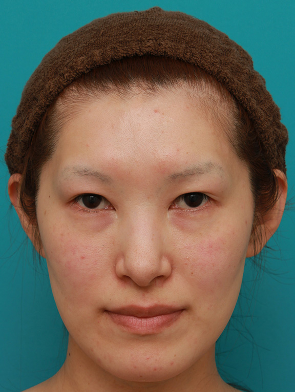 症例写真,目尻切開+タレ目形成（グラマラスライン）で外斜視気味の目を改善させた症例写真の術前術後画像,Before,ba_panda016_b01.jpg