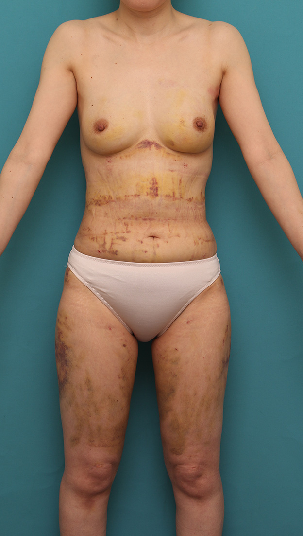 症例写真,生理食塩水豊胸バッグを除去し、同時にバスト脂肪注入した症例の術前術後画像,1週間後,mainpic_prosthesis_removal002c.jpg