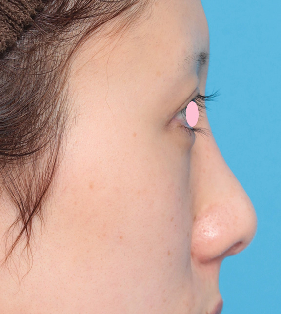 鼻翼縮小（小鼻縮小）,鼻骨切り幅寄せと小鼻縮小手術をした症例写真の術前術後画像,Before,ba_honekiri007_b04.jpg