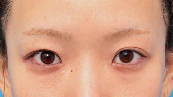 目の下のクマ治療,目頭切開、目尻切開、二重まぶた全切開法、目の下脂肪取りを同時に行った症例,Before,ba_sekkai044_b01.jpg