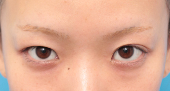 目の下の脂肪取り,目頭切開、目尻切開、二重まぶた全切開法、目の下脂肪取りを同時に行った症例,Before,ba_sekkai044_b02.jpg