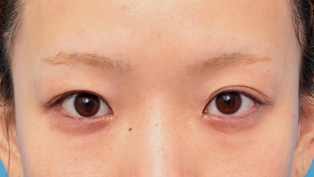 目の下の脂肪取り,目頭切開、目尻切開、二重まぶた全切開法、目の下脂肪取りを同時に行った症例,手術前,mainpic_sekkai044a.jpg