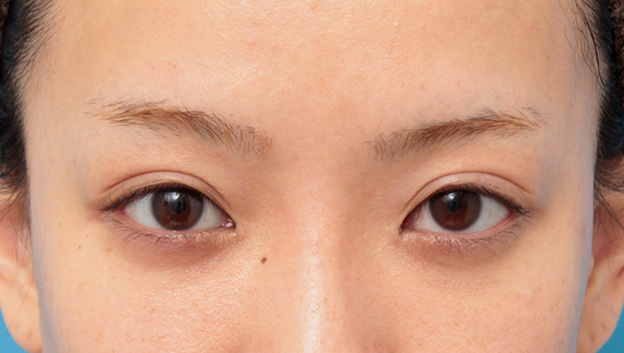 目の下のクマ治療,目頭切開、目尻切開、二重まぶた全切開法、目の下脂肪取りを同時に行った症例,9ヶ月後,mainpic_sekkai044i.jpg