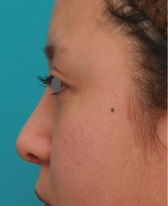 隆鼻術（シリコンプロテーゼ）,他院で受けたゴアテックス+鼻中隔延長を自然な形に修正した症例の術前術後画像,After（修正手術前）
他院で手術をした3週間後,ba_nose_modify015_b04.jpg