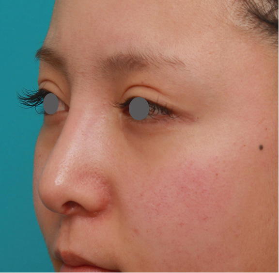 症例写真,他院で受けたゴアテックス+鼻中隔延長を自然な形に修正した症例の術前術後画像,Before,ba_nose_modify015_b03.jpg