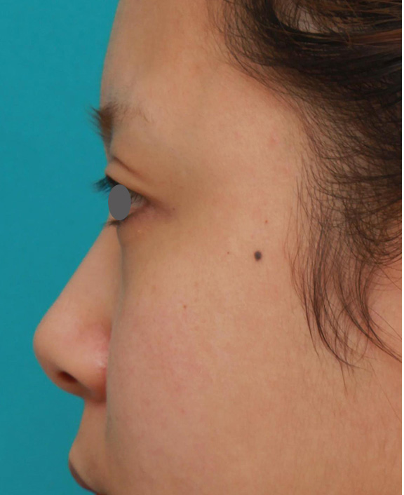 隆鼻術（シリコンプロテーゼ）,他院で受けたゴアテックス+鼻中隔延長を自然な形に修正した症例の術前術後画像,Before,ba_nose_modify015_b04.jpg