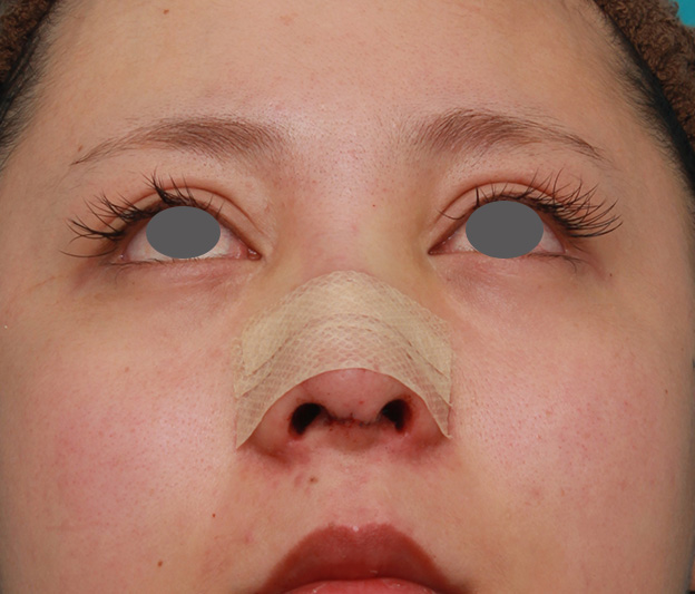 隆鼻術（シリコンプロテーゼ）,他院で受けたゴアテックス+鼻中隔延長を自然な形に修正した症例の術前術後画像,当院で修正手術をした直後,mainpic_nose_modify015i.jpg