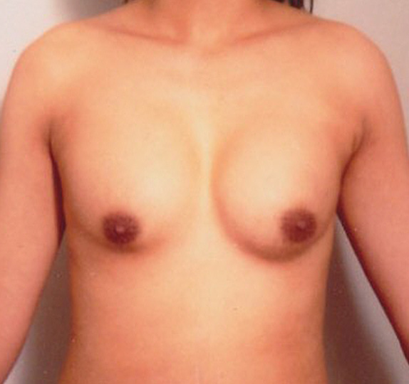 他院で受けた豊胸手術（シリコンプロテーゼ）の修正症例　大胸筋下から乳腺下へ入れ替え,Before,ba_modify07_b.jpg