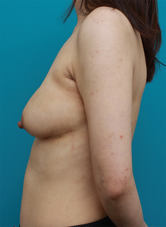 豊胸手術（シリコンプロテーゼ）,他院で行われた豊胸手術を修正した症例写真,After（1ヶ月後）,ba_modify10_b.jpg