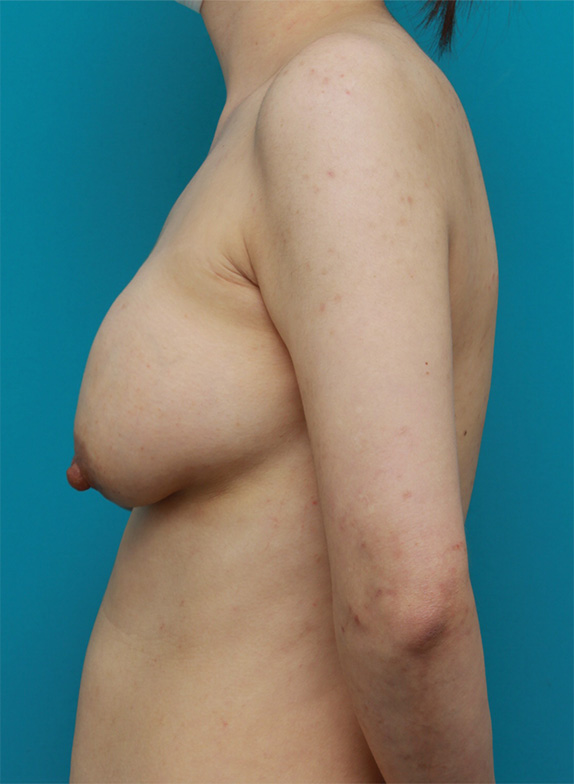 豊胸手術（シリコンプロテーゼ）,他院で行われた豊胸手術を修正した症例写真,Before,ba_modify10_b.jpg