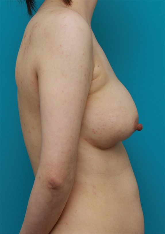 豊胸手術（シリコンプロテーゼ）,他院で行われた豊胸手術を修正した症例写真,Before,ba_modify11_b.jpg