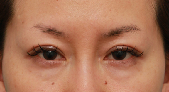 垂れ目（パンダ目）形成（グラマラスライン／下眼瞼下制術）,タレ目形成（グラマラスライン）をした30代後半女性の症例写真,Before,ba_panda017_b01.jpg