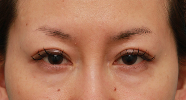垂れ目（パンダ目）形成（グラマラスライン／下眼瞼下制術）,タレ目形成（グラマラスライン）をした30代後半女性の症例写真,手術前,mainpic_panda017a.jpg