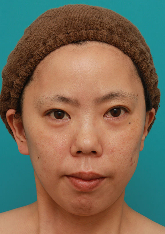 ミディアムフェイスリフト,ミディアムフェイスリフトを施した30代後半女性の症例写真,After（6ヶ月後）,ba_mediumlift007_a01.jpg