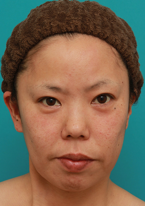 ミディアムフェイスリフト,ミディアムフェイスリフトを施した30代後半女性の症例写真,Before,ba_mediumlift007_b01.jpg