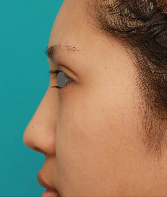 隆鼻術（シリコンプロテーゼ）,鼻シリコンプロテーゼ+鼻先耳介軟骨移植+小鼻縮小を同時に行った症例写真,After（6ヶ月後）,ba_ryubi1034_b04.jpg