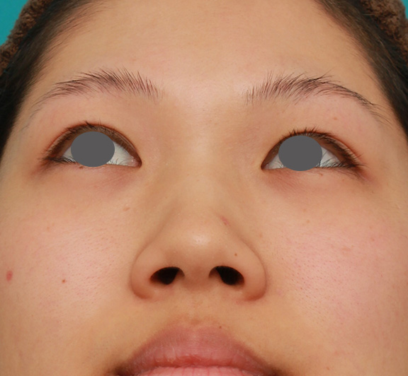 隆鼻術（シリコンプロテーゼ）,鼻シリコンプロテーゼ+鼻先耳介軟骨移植+小鼻縮小を同時に行った症例写真,Before,ba_ryubi1034_b02.jpg