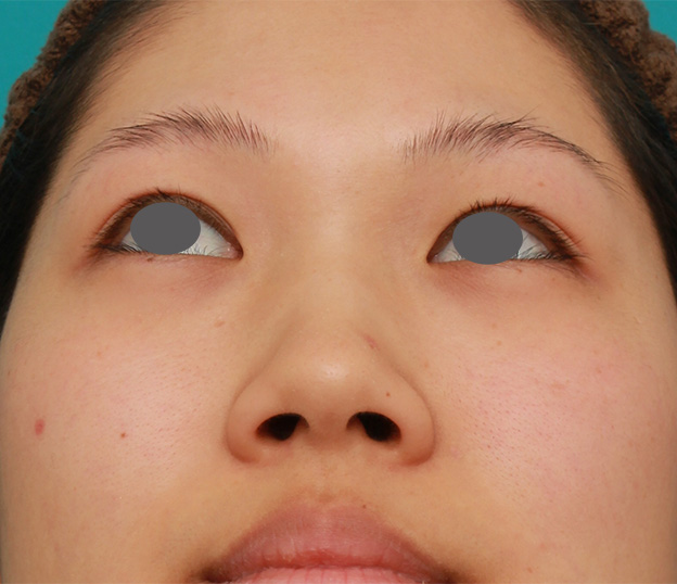 隆鼻術（シリコンプロテーゼ）,鼻シリコンプロテーゼ+鼻先耳介軟骨移植+小鼻縮小を同時に行った症例写真,手術前,mainpic_ryubi1034f.jpg