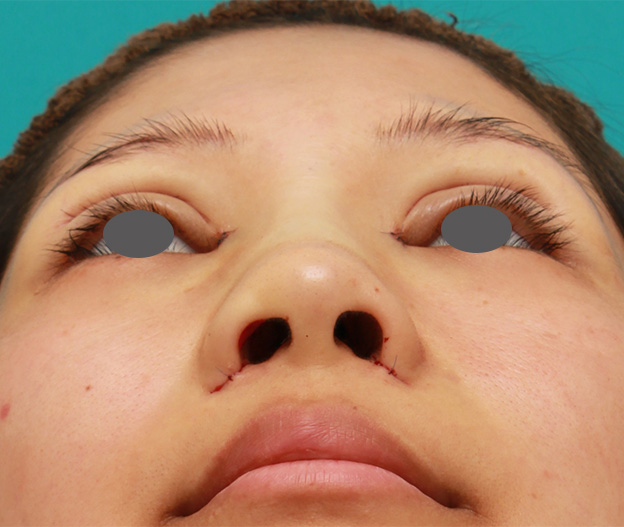鼻翼縮小（小鼻縮小）,鼻シリコンプロテーゼ+鼻先耳介軟骨移植+小鼻縮小を同時に行った症例写真,手術直後,mainpic_ryubi1034g.jpg