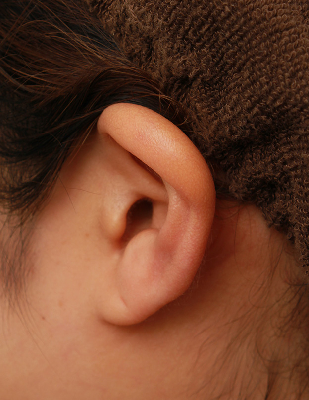 鼻翼縮小（小鼻縮小）,鼻シリコンプロテーゼ+鼻先耳介軟骨移植+小鼻縮小を同時に行った症例写真,手術前の耳の状態,mainpic_ryubi1034k.jpg