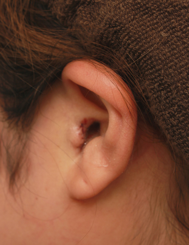 鼻翼縮小（小鼻縮小）,鼻シリコンプロテーゼ+鼻先耳介軟骨移植+小鼻縮小を同時に行った症例写真,手術直後の耳の状態,mainpic_ryubi1034l.jpg