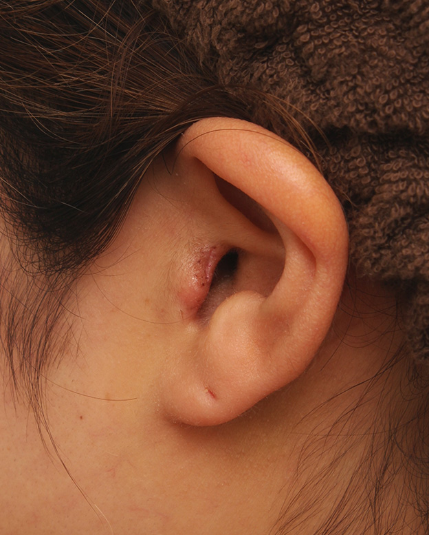 隆鼻術（シリコンプロテーゼ）,鼻シリコンプロテーゼ+鼻先耳介軟骨移植+小鼻縮小を同時に行った症例写真,1週間後の耳の状態,mainpic_ryubi1034m.jpg