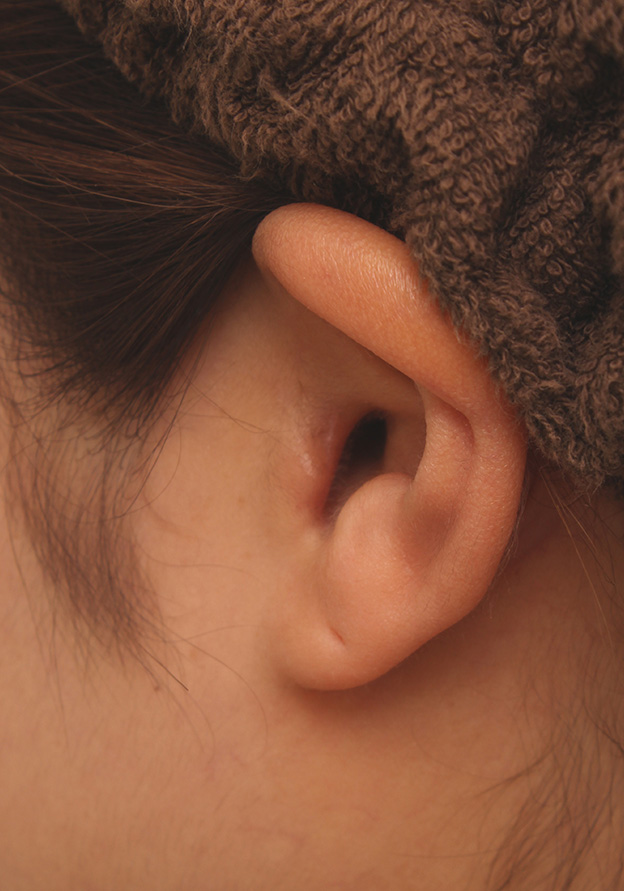 鼻翼縮小（小鼻縮小）,鼻シリコンプロテーゼ+鼻先耳介軟骨移植+小鼻縮小を同時に行った症例写真,3週間後の耳の状態,mainpic_ryubi1034n.jpg