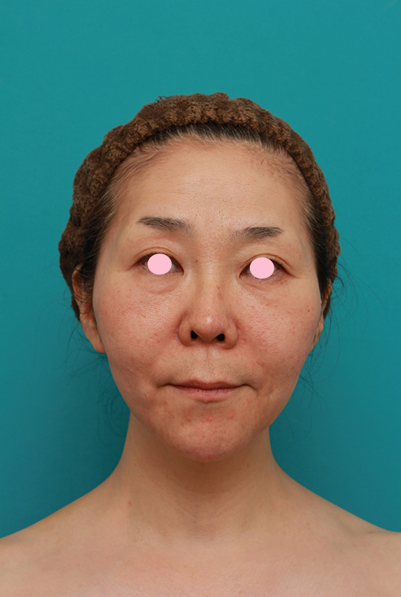 症例写真,Vシェイプリフト（ヒアルロン酸注射）の症例 頬のたるみ、ゴルゴライン、法令線、マリオネットラインが気になる女性,After,ba_v_shapelift001_b01.jpg