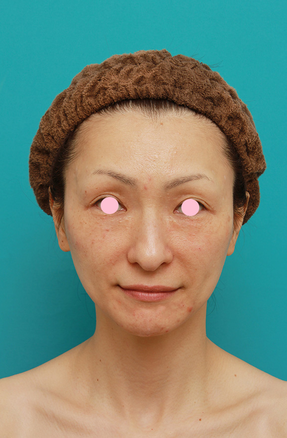 症例写真,Vシェイプリフト（ヒアルロン酸注射）の症例 加齢による顔の変化が気になる女性,After,ba_v_shapelift003_b01.jpg