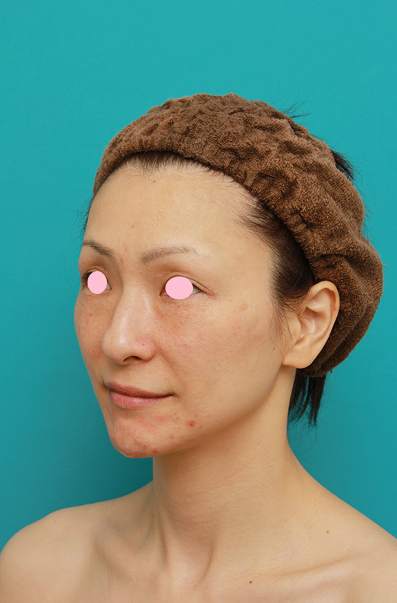 Vシェイプリフト（ヒアルロン酸注射）,Vシェイプリフト（ヒアルロン酸注射）の症例 加齢による顔の変化が気になる女性,After,ba_v_shapelift003_b02.jpg