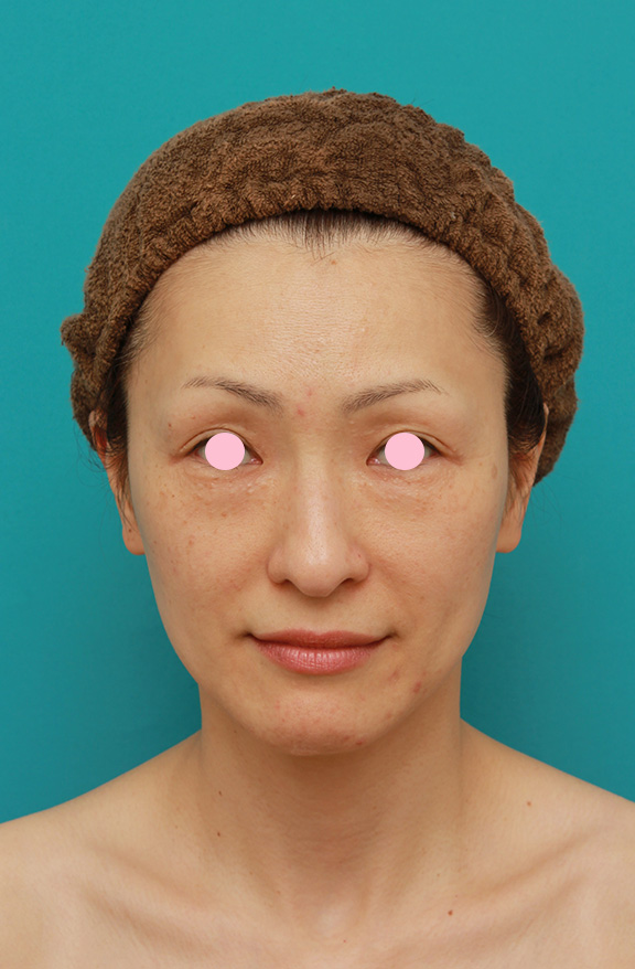 症例写真,Vシェイプリフト（ヒアルロン酸注射）の症例 加齢による顔の変化が気になる女性,Before,ba_v_shapelift003_b01.jpg