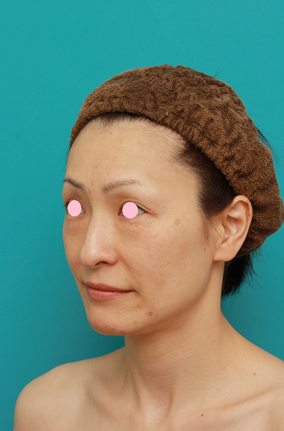 症例写真,Vシェイプリフト（ヒアルロン酸注射）の症例 加齢による顔の変化が気になる女性,Before,ba_v_shapelift003_b02.jpg