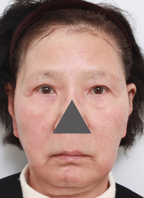 サーマクール,70代女性の顔にサーマクールを行い、たるみが改善した症例写真,After（3ヶ月後）,ba_thermacool016_b01.jpg