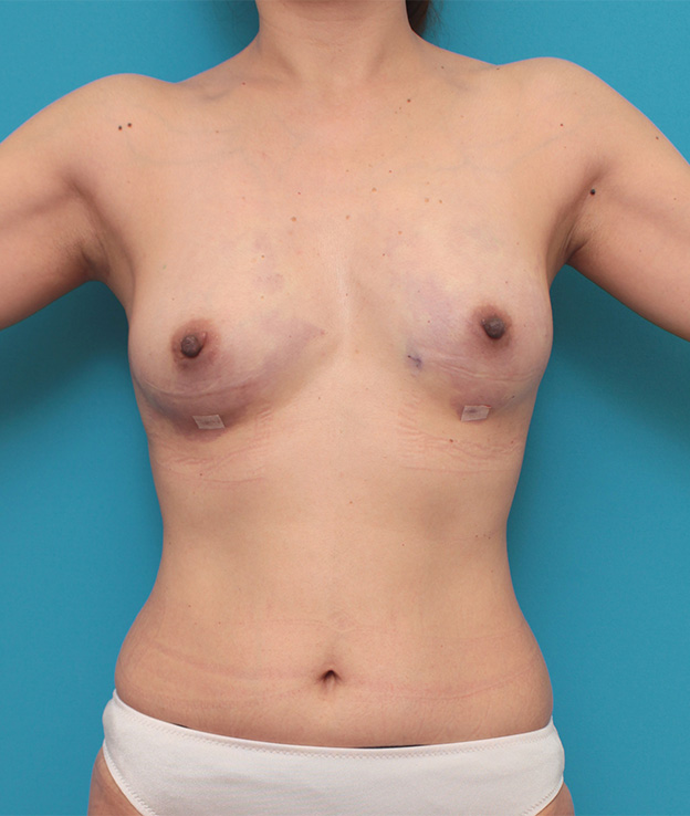 症例写真,40代女性の細い身体の太もも全体から脂肪吸引し、バストに脂肪注入豊胸した症例写真,手術直後,mainpic_shibokyuin024b.jpg