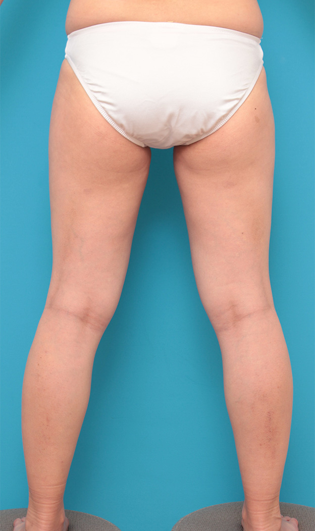 脂肪吸引,40代女性の細い身体の太もも全体から脂肪吸引し、バストに脂肪注入豊胸した症例写真,6ヶ月後,mainpic_shibokyuin024r.jpg