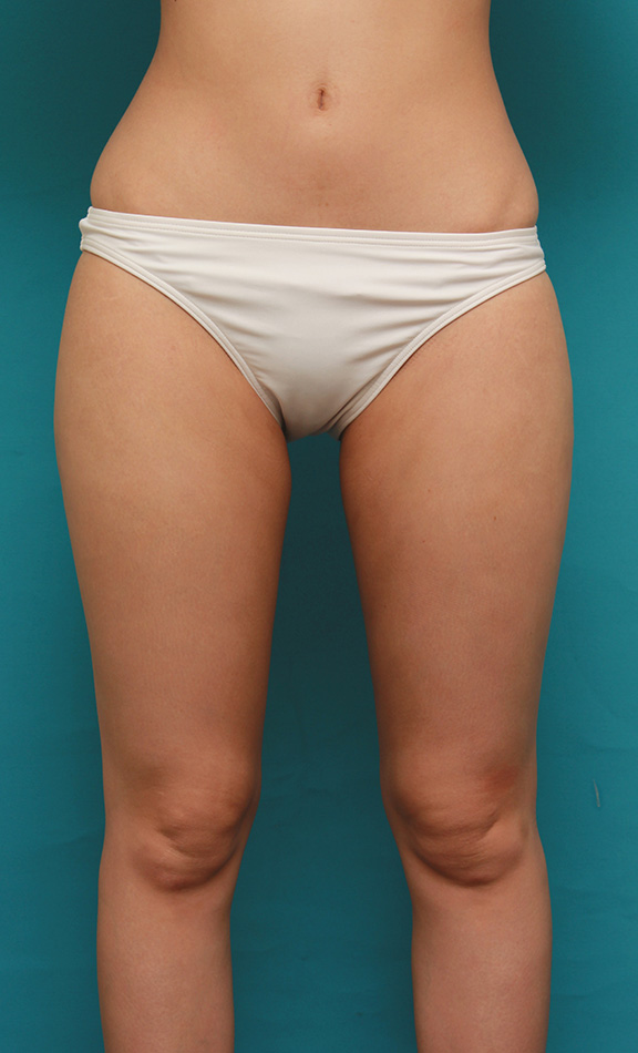 イタリアン・メソシェイプ（イタリアンメソセラピー）・脂肪溶解注射で太もも~お尻にかけて全体的に細くした20代女性の症例写真,After（6回注射後2ヶ月）,ba_meso035_a01.jpg