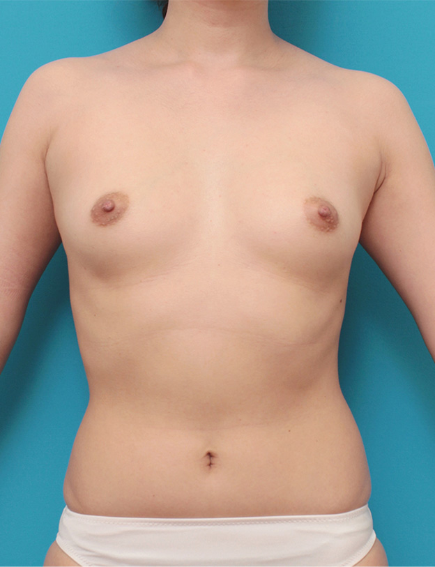豊胸手術（シリコンプロテーゼ）,豊胸手術で乳腺下に245ccのシリコンプロテーゼを入れた症例写真,手術前,mainpic_hokyo025a.jpg