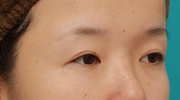 眼瞼下垂（がんけんかすい）,眼球自体が小さく開きも悪い目に対して、目頭切開+眼瞼下垂手術で目を一回り大きくした症例写真,After（6ヶ月後）,ba_megashira047_b02.jpg