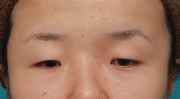 眼瞼下垂（がんけんかすい）,眼球自体が小さく開きも悪い目に対して、目頭切開+眼瞼下垂手術で目を一回り大きくした症例写真,手術前,mainpic_megashira047a.jpg