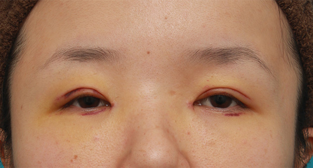 症例写真,眼球自体が小さく開きも悪い目に対して、目頭切開+眼瞼下垂手術で目を一回り大きくした症例写真,1週間後,mainpic_megashira047c.jpg