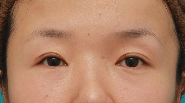 眼瞼下垂（がんけんかすい）,眼球自体が小さく開きも悪い目に対して、目頭切開+眼瞼下垂手術で目を一回り大きくした症例写真,3週間後,mainpic_megashira047d.jpg