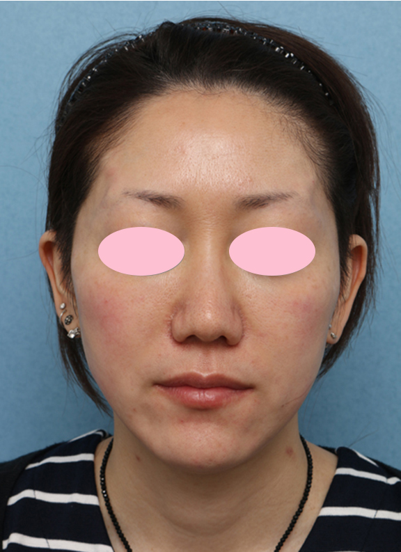 Vシェイプリフト（ヒアルロン酸注射）,Vシェイプリフト（ヒアルロン酸注射）の症例 両頬をリフトアップしたい女性,After,ba_v_shapelift004_b01.jpg