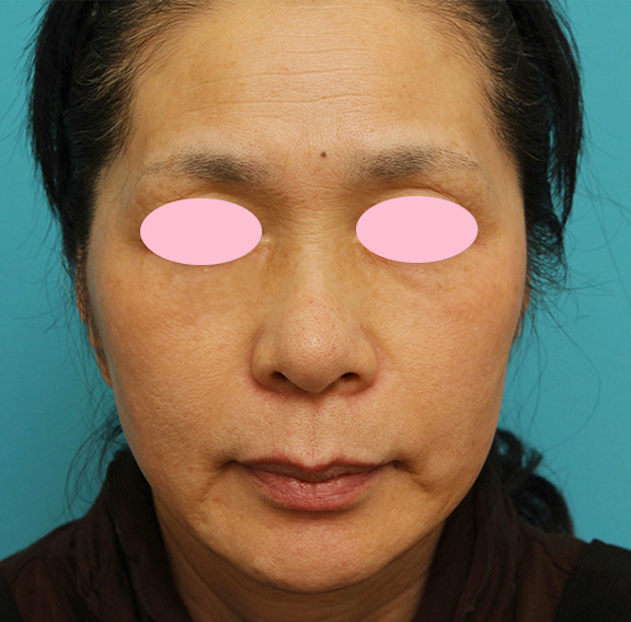 症例写真,トレチノイン・ハイドロキノンの症例 肝斑治療をした女性,After,ba_tore_hydro002_b01.jpg