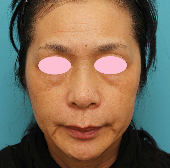 症例写真,トレチノイン・ハイドロキノンの症例 肝斑治療をした女性,Before,ba_tore_hydro002_b01.jpg