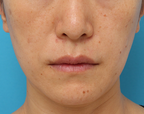 ボツリヌストキシン注射（口角を上げる）,ボツリヌストキシン注射で口角を上げた40代後半女性の症例写真,Before,ba_lipsup_botox004_b01.jpg